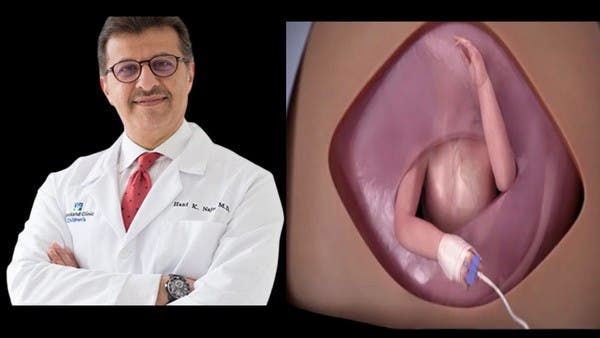 عملية جراحية مبهرة لجنين في بطن أمه .. الطبيب السعودي يروي التفاصيل 