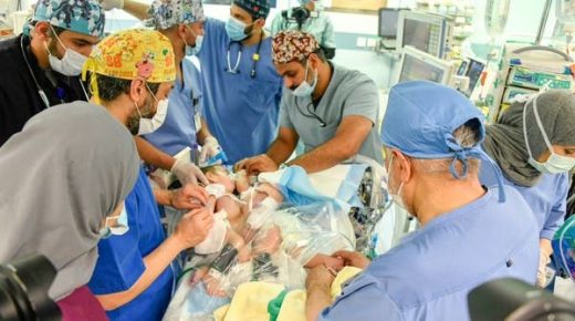 السعودية.. نجاح عملية فصل التوأم السيامي العراقي “علي وعمر”