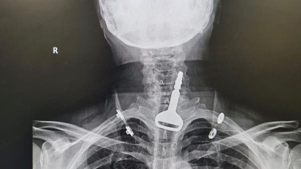 أربعيني سعودي يبتلع مفتاح سيارته.. وهذا ما حدث