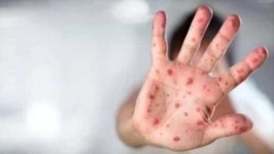 الصحة العالمية: أزمة شرق الكونغو الديمقراطية تزيد خطر انتقال جدري القردة